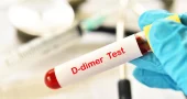 d-dimer-test-price