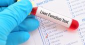 liver-function-test-blood-sample-102023306